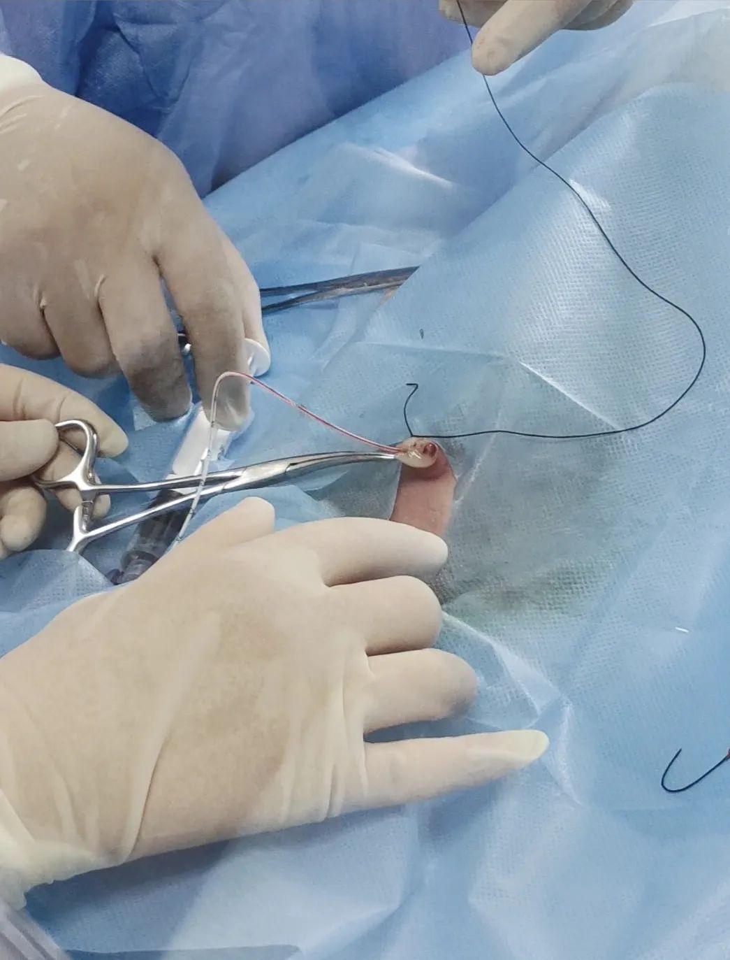 莘县人民医院脐静脉置管术:为新生儿打通"生命的绿色通道"